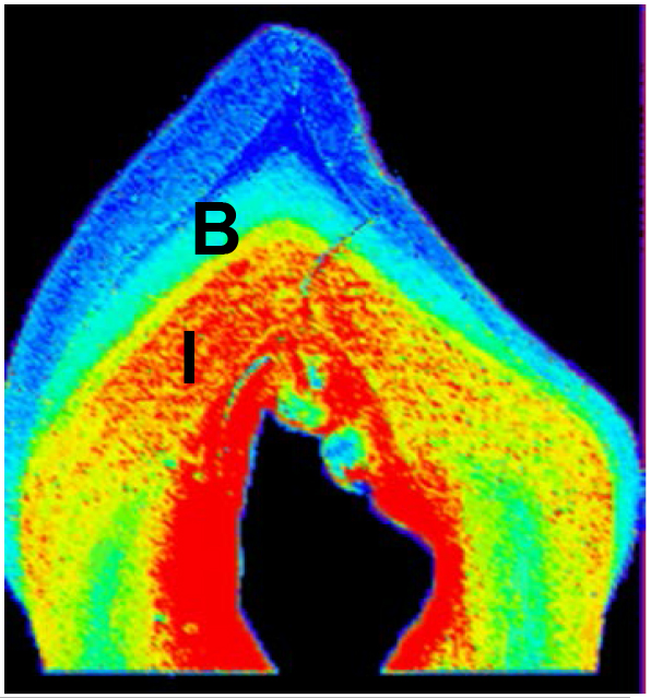Radiographic image of a baby tooth, in colors ranging from blue to red