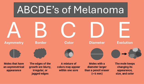 Know Your ABCDEs Graphic 600x375